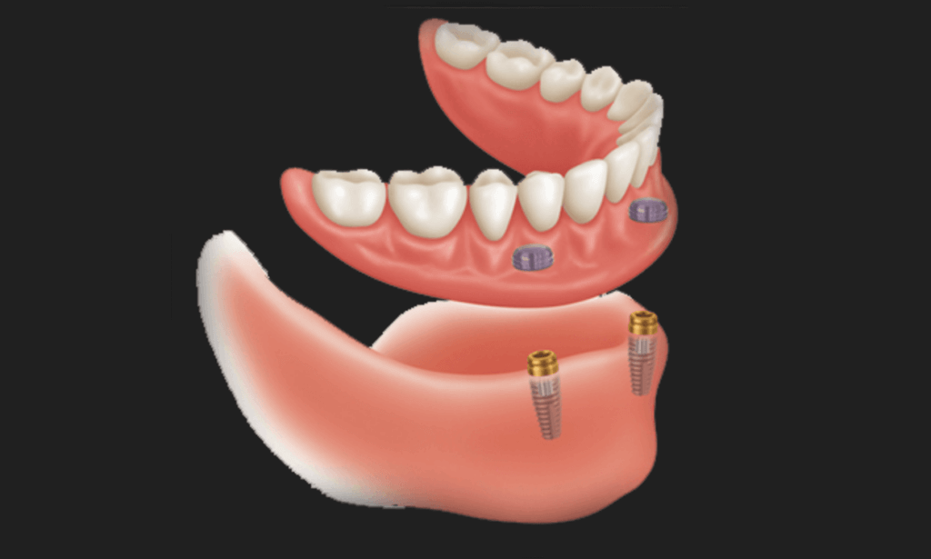 치아 전체 임플란트 과정