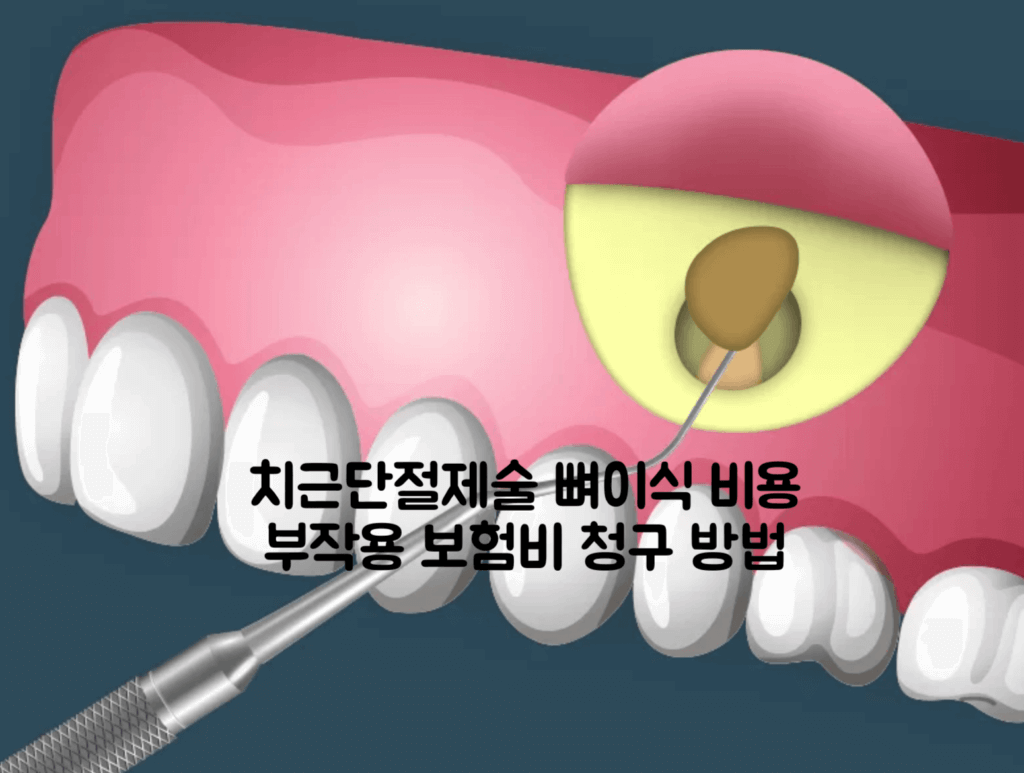 치근단절제술 부작용