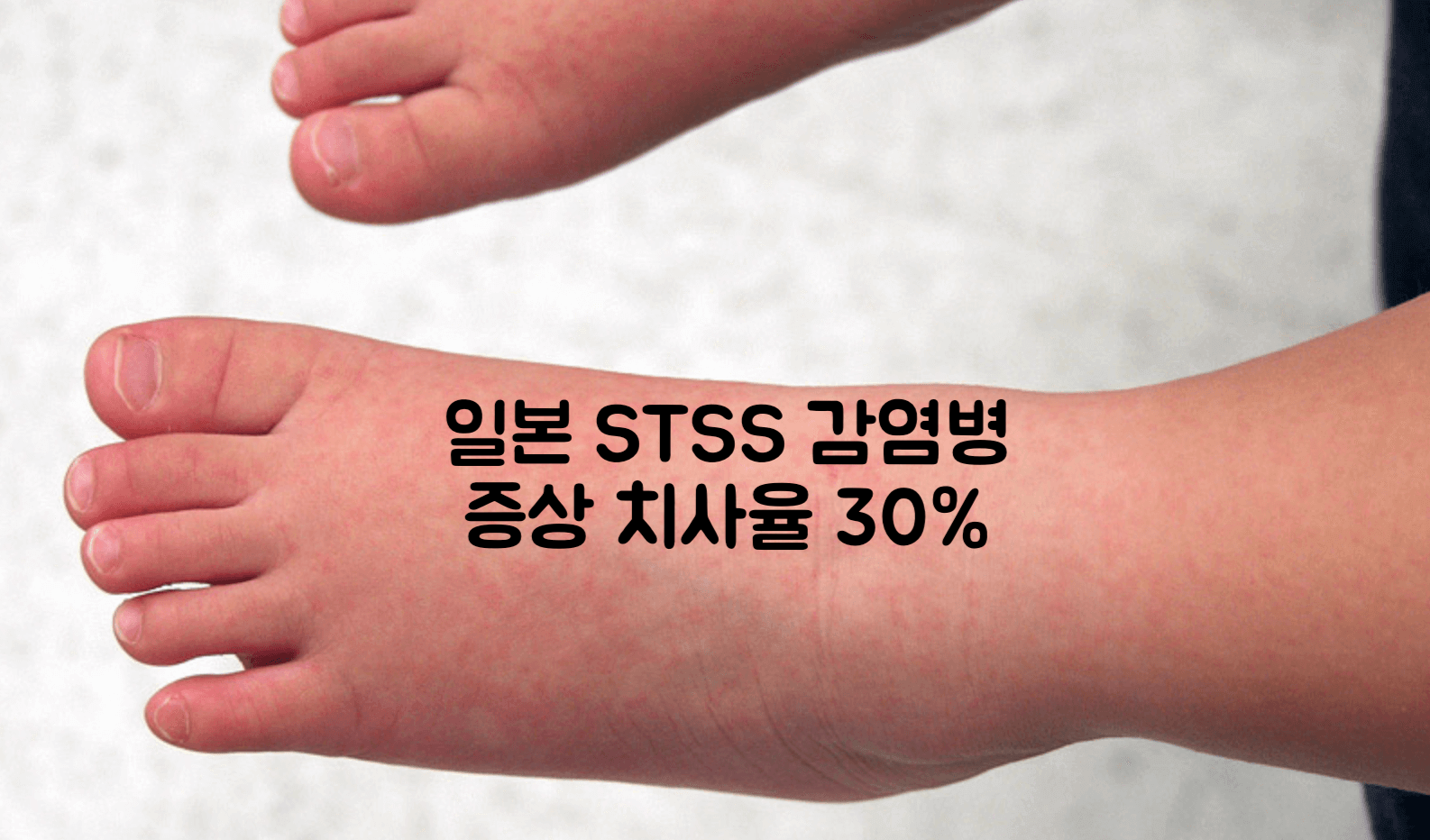 일본 STSS 감염병 증상 치사율 30%